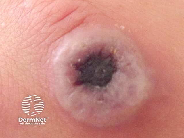 Central necrosis is developing in the blister as the cowpox lesion matures