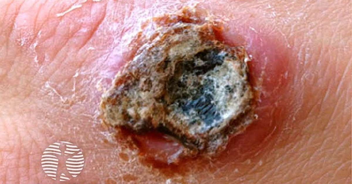 Cowpox image