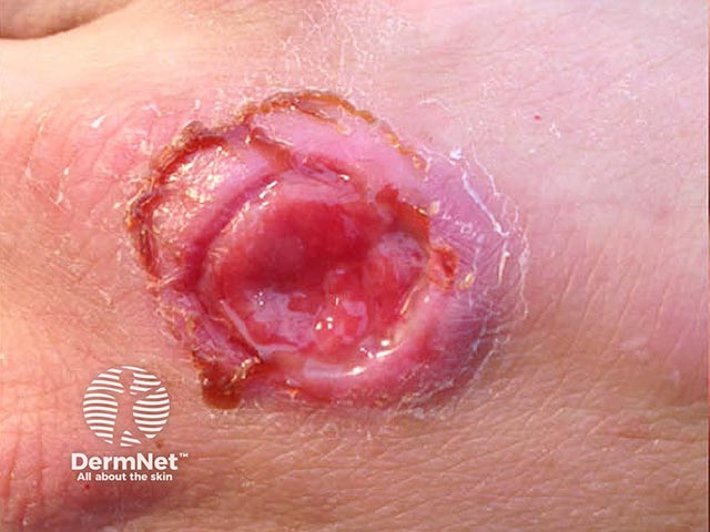 The ulcer remaining after eschar separation