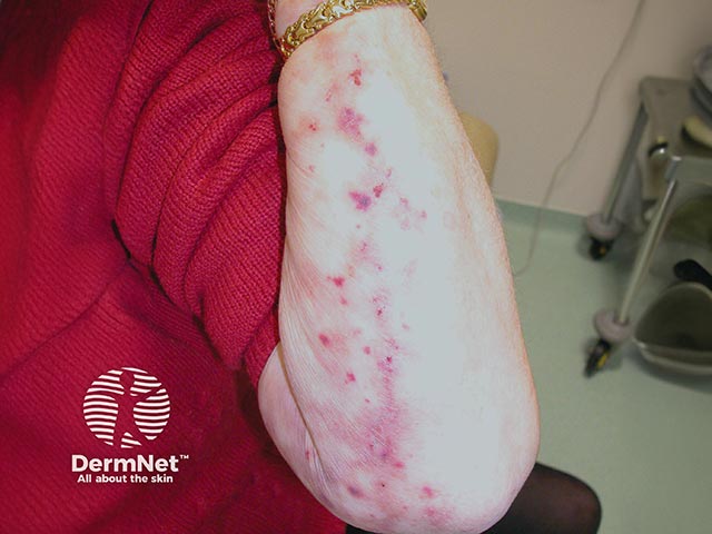 Retiform purpura on the arm - note that some of the lesions have a jagged edge. There was a myeloma-associated cryoglobulinaemia