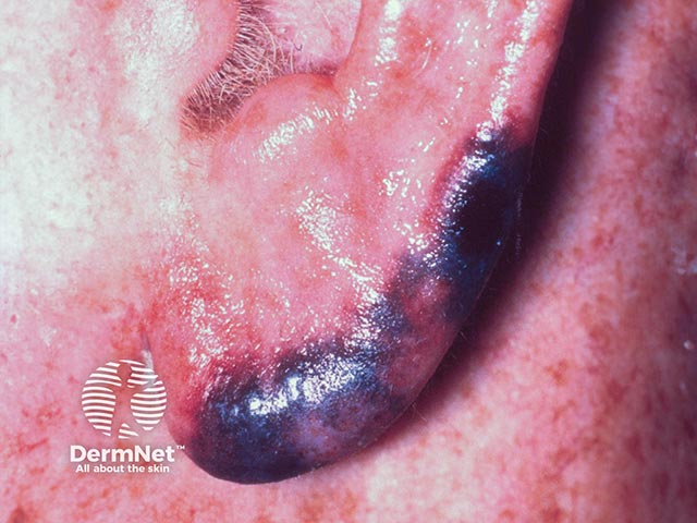 Cold-induced purpura on the earlobe due to a cryoglobulinaemia