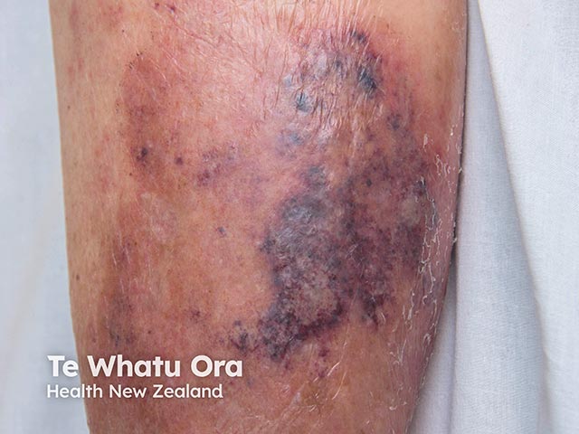 A haemorrhagic cellulitis-like eruption due to cryptococcosis