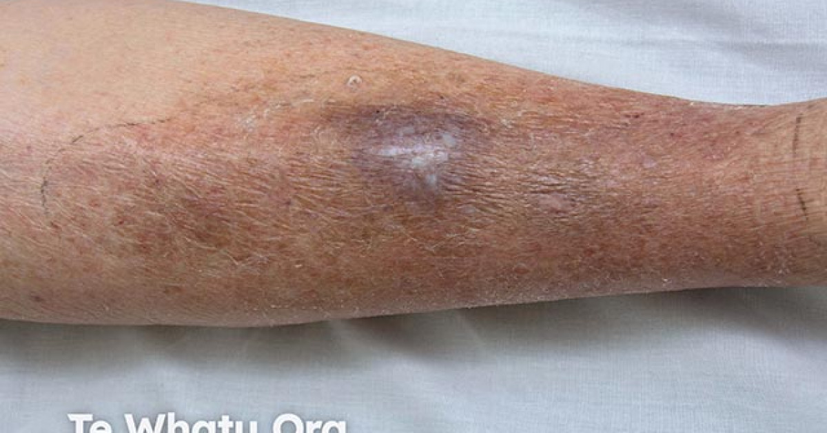 Cryptococcosis image