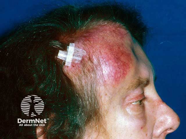 Sclap and forehead tumour due to B cell lymphoma