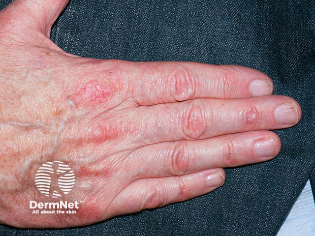 Streaks of erythema over the knuckles due to long-term hydroxycarbamide exposure