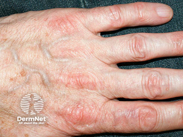 Streaks of erythema over the knuckles due to long-term hydroxycarbamide exposure