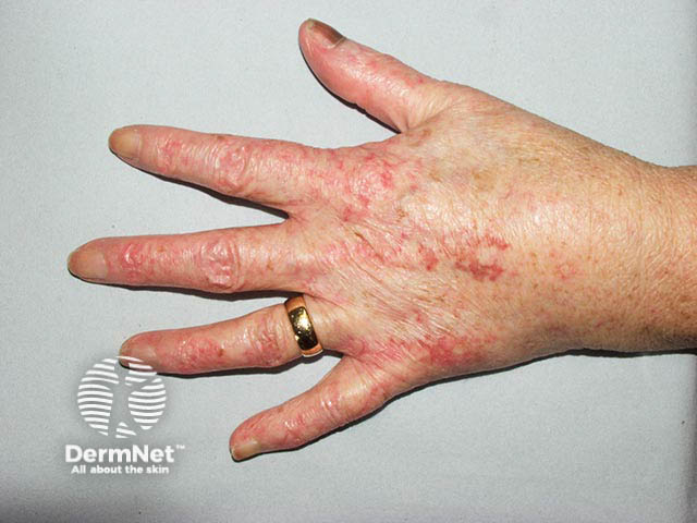 Poikilodermatous changes over the dorsal fingers and hand due to long-term hydroxycarbamide exposure. Note also the thumbnail melanonychia due to the drug