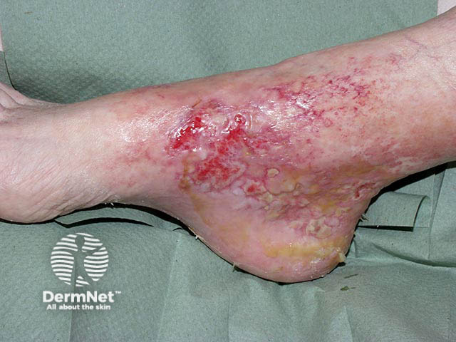 Painful medial maleolar ulceration due to hydroxyurea