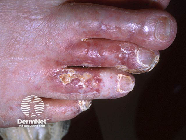 Painful toe ulcers due to hydroxyurea 