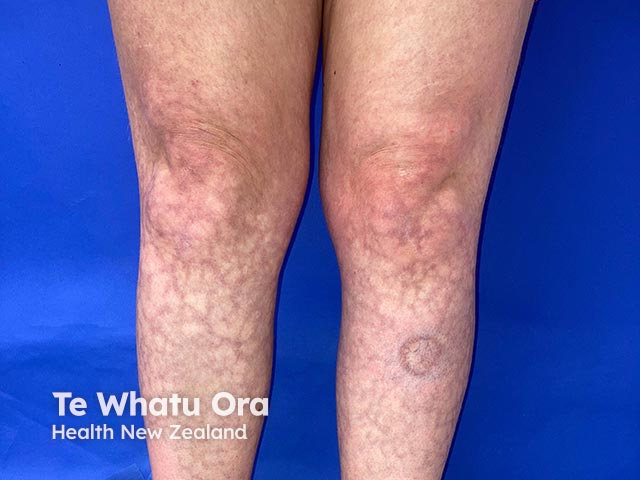 A net-like appearance of livedo reticularis due to amantadine administration - she also has necrobiosis lipoidica on the left shin