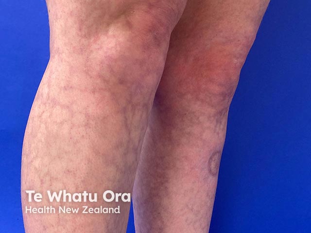 A net-like appearance of livedo reticularis due to amantadine administration 