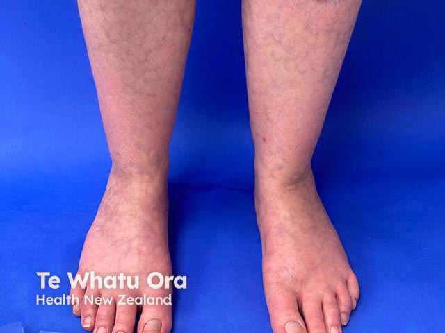 A net-like appearance of livedo reticularis on the feet due to amantadine administration 