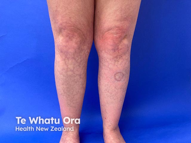 A net-like appearance of livedo reticularis due to amantadine administration. Coincidentally, she has necrobiosis lipoidica on the left shin