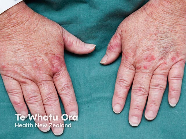 Erythema on the dorsal hands as part of azathioprine hypersensitivity syndrome