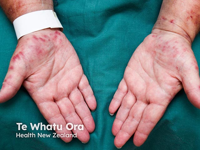 Palmar lesions arising as part of azathioprine hypersensitivity syndrome
