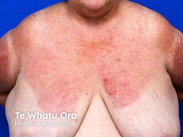 A photosensitive eruption arising as part of azathioprine hypersensitivity syndrome