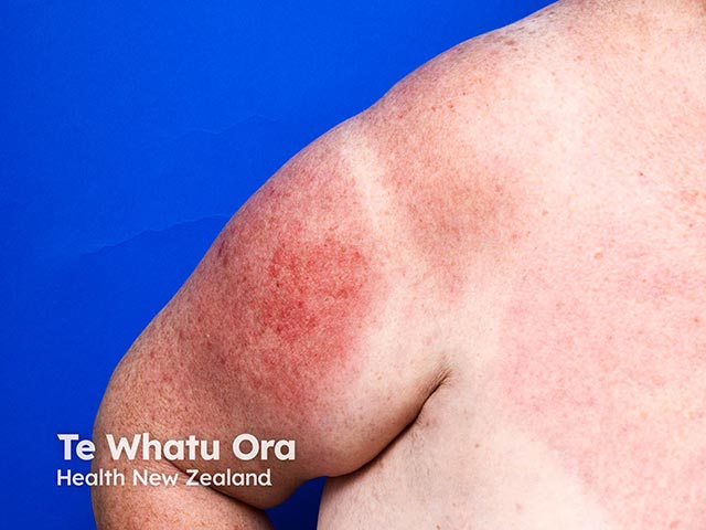 A photosensitive eruption arising as part of azathioprine hypersensitivity syndrome