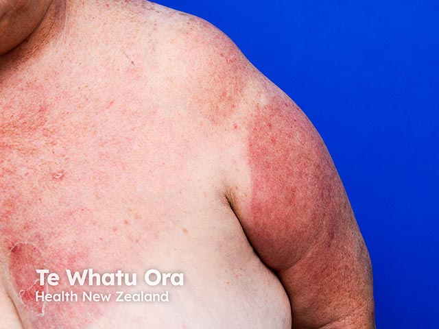 A photosensitive eruption arising as part of azathioprine hypersensitivity syndrome