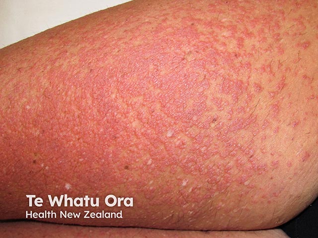 Erythematous papules with occasional pustules as part of an azathioprine hypersensitivity syndrome eruption