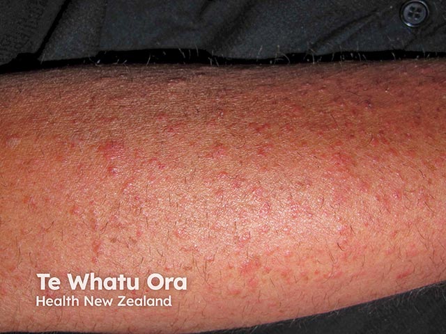 A dermatitis due to azathioprine hypersensitivity syndrome