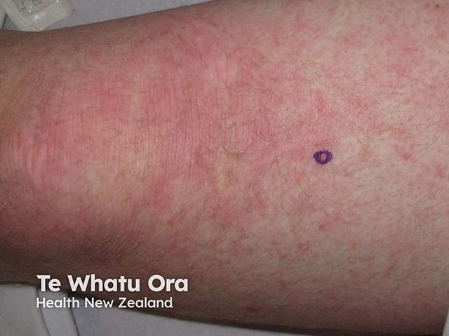 A maculopapular eruption due to azathioprine hypersensitivity syndrome