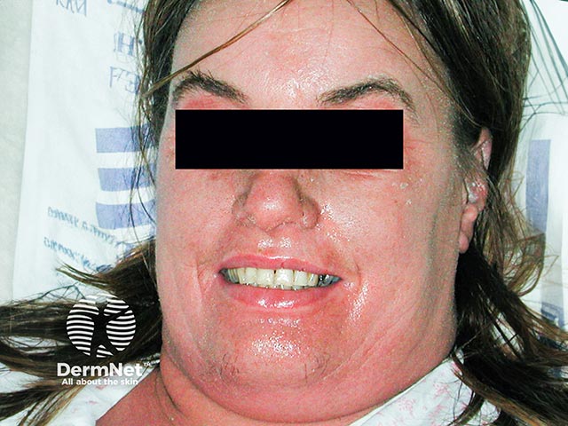 Facial erythema and oedema - a frequent clue to DRESS syndrome