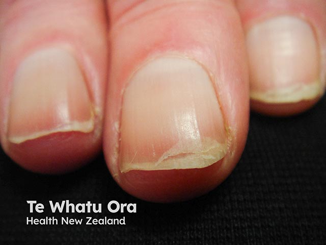Lamellar nail splitting due to a Bruton kinase inhibitor 