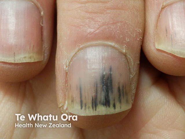 Florid splinter haemorrhages due to a Bruton kinase inhibitor