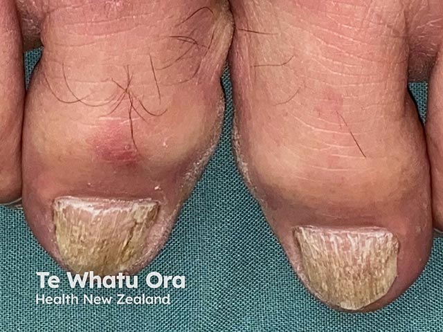Nail dystrophy during Bruton kinase inhibitor administration