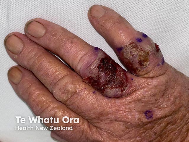 Acute febrile neutrophilic dermatosis of the dorsal hands due to a Bruton kinase inhibitor