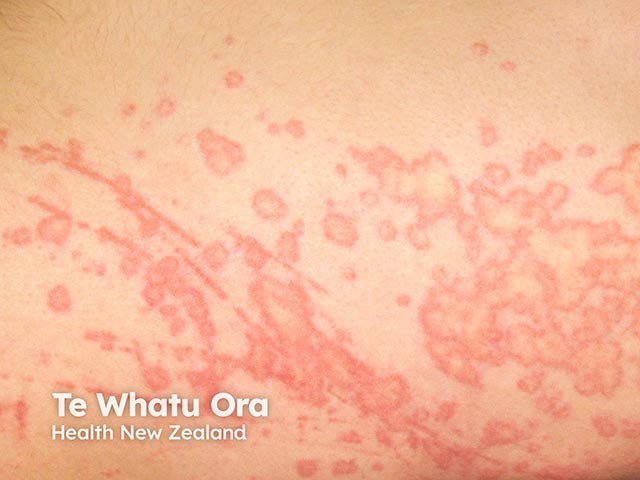 Acute annular urticaria arising during Bruton kinase inhibitor treatment
