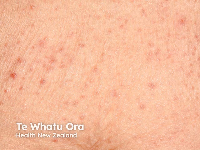 Follicular keratosis pilaris-like papules on the back arising during Bruton kinase inhibitor administration