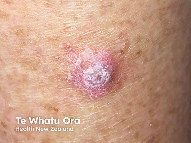 A squamous cell carcinoma arising during Bruton kinase inhibitor therapy
