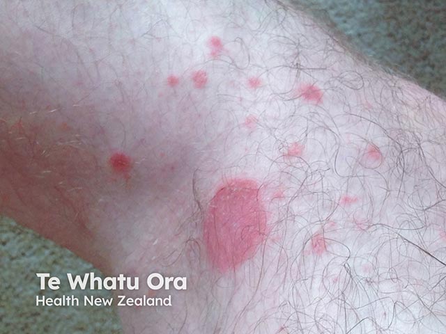 A pityriasis rosea-like eruption during Bruton kinase inhibitor administration