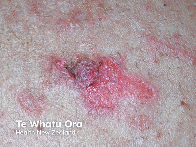 Erosions and superficial blisters due to pemphigus vulgaris arising during Bruton kinase inhibition