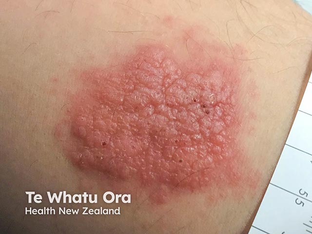 Herpes simplex arising during Bruton kinase inhibitor administration
