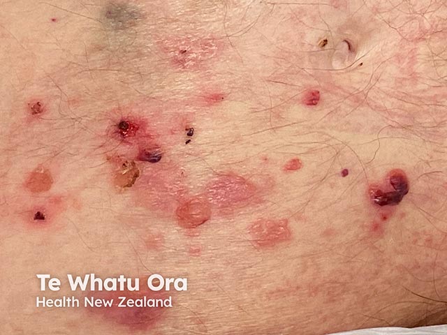 Bullous pemphigoid arising during Bruton kinase inhibitor administration