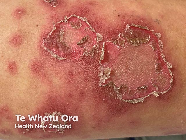Subacute cutaneous lupus erythematosus due to a Bruton kinase inhibitor