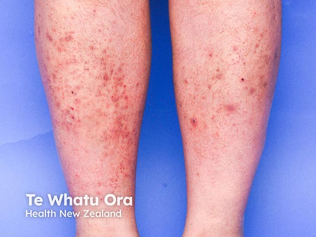 A dermatitic eruption due to a Bruton kinase inhibitor