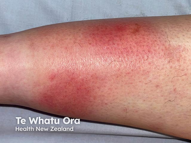 Erythema nodosum due to a Bruton kinase inhibitor