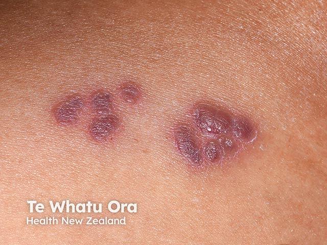 A violaceous cutaneous reaction due to a Bruton kinase inhibitor