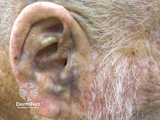 Slate-grey pigmentation on the ears due to long-term minocycline ingestion