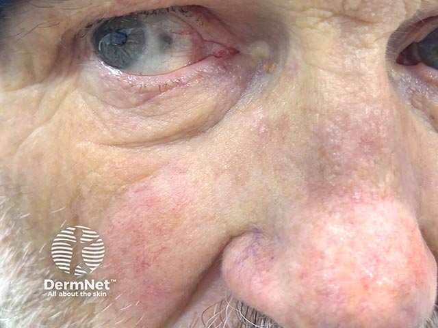 Scleral pigmentation due to minocycline