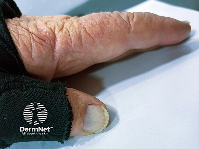 Thumb nail pigmentation due to long term minocycline ingestion