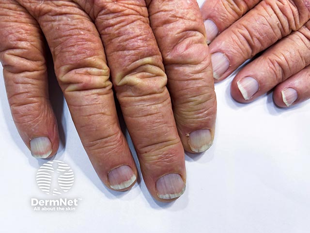 Fingernail pigmentation due to long-term minocycline ingestion