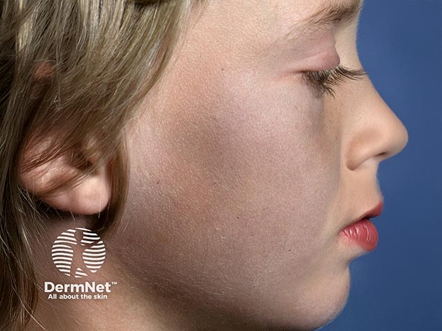 Blue facial pigmentation due to long-term amiodarone administration