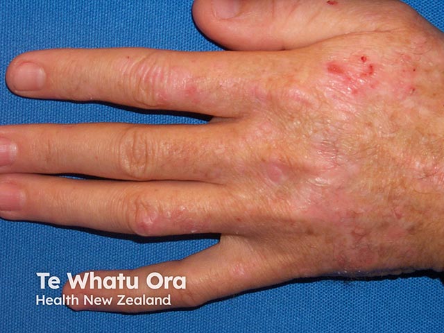 A renal transplant recipient on long term azathioprine - there is accelerated photoaging and keratoses