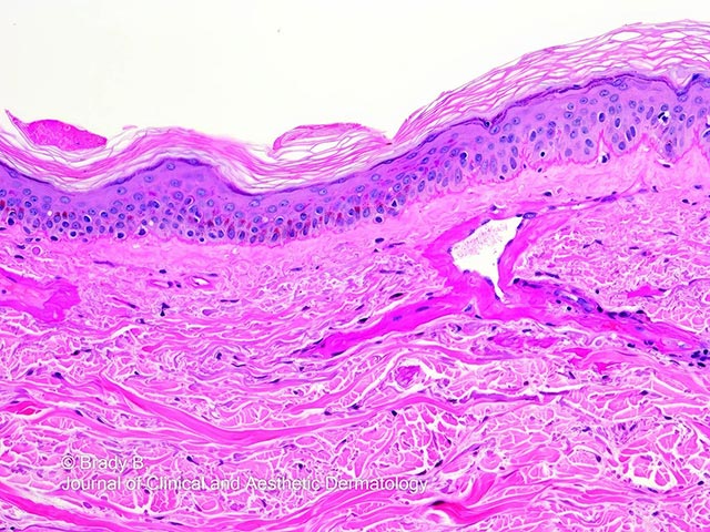 Collagen can be seen sleeving the upper dermal telangiectatic vessels