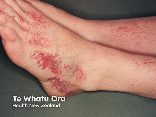 Telangiectasia over the foot - histology showed cutaneous collagenous vasculopathy