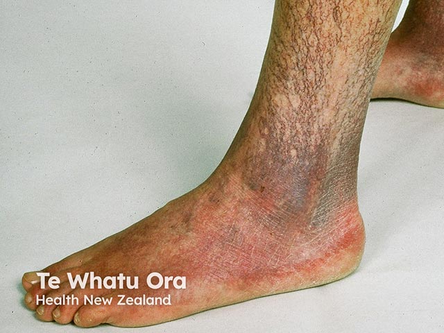 Cutaneous collagenous vasculopathy in skin of colour